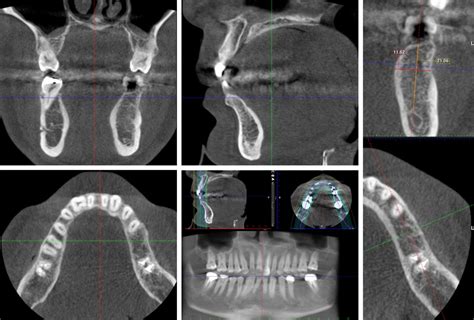 Dental CT scan vs. Cone Beam CT: an overview .